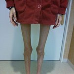 [추억파리여] (약혐)<b>열도</b>의 26.9kg 거식증녀