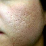 여드름흉터치료후기 내 피부 어때?