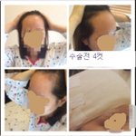 넓은이마에서 좁은이마로 헤어라인 <b>모발</b>이식 후기