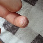 [도와주세요] [혐] <b>소독</b>후에 피부가 이상해요