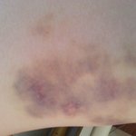 [EXO] 혐주의)허벅지 <b>주사</b>맞았는데