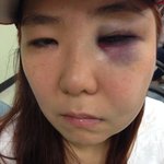 헤어지자고 했다가 맞았습니다.. (사진첨부) 형사<b>처벌</b> 저좀 도와주세요