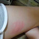 [EXO] ㅅㄷ<b>오늘</b><b>하루</b>동안 모기물린거 ㅅㅂ