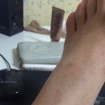 (<b>사진</b>有)몸에서뭐가나는데 <b>무슨</b>병인가요 ?두드러기일까요 ??