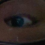 쌍꺼풀 이상하게 <b>두겹</b>으로 변했는데