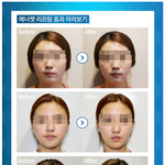 습한 여름, 열이 아닌 <b>에너</b>젯리프팅으로 탄력있는 얼굴 완성하세요...