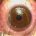 [공토다] 오싹한 <b>라식</b> 수술 실황 - 약혐