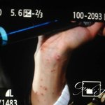 [EXO] 타오 정글가서 벌레한테 물린것좀봐.....