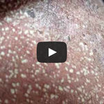 [공미니] 혐] <b>염증</b>성 여드름