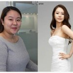 [EXO] 바노바기 성형외과 <b>수술</b>전후