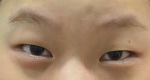 [EXO] <b>쌍수전후</b>