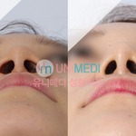 [EXO] 콧볼축소주사만 맞아도 <b>코필러</b> 효과도 있음