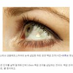 [추억파리여] 안구에 보석을 <b>삽입</b>하는 성형수술