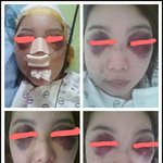 상해로 인한 뇌출혈과 안면골절..