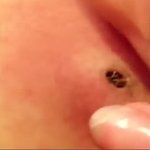 [헐랭] <b>뿌리</b> 깊은 대형 블랙헤드의 최후