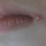 [댓글부탁] 입옆에여드름ㅠㅠ(사진有)