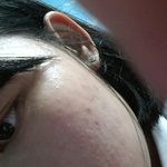 [EXO] (혐주의)제발제발제발ㅠㅠ피부극복한사람들제발