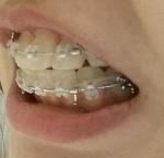 [꼭봐주세요] 비<b>발치</b> 교정으로 뻐드렁니가 되었는데.. 치아를 이런...