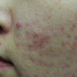 여드름치료 윤앤<b>송한</b>의원 후기