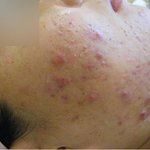 [여드름] 여드름자국 윤앤<b>송한</b>의원 치료후기에요