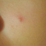 [EXO] 이거여드름어카냐ㅜㅜ
