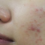 <b>화농성</b>여드름 확실한 윤앤송한의원 후기