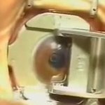 [아리] <b>라식</b>수술 실제상황