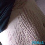 [아리] 임신중 튼살