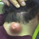 [아리] 세상에서 가장 큰 여드름