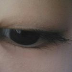 [댓글부탁] 앞트임과 코성형중 어떤걸해야할까요?