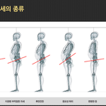 척추측만증 에 <b>일자목</b> 에 턱관절..