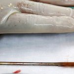 [추억파리여] 쇠막대 삽입했다가 죽다 살아난 남자