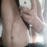 [추억파리여] 열대거미 사람 피부로 들어가 3일 동거