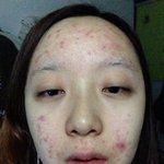 [뷰티] 얼굴 여드름 없애기~ 8개월 간의 노력ㅠㅠㅠㅠ 인간승리