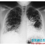 [아리] <b>수은</b>먹고 자살 시도한 여자의 엑스레이