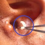 [추억파리여] 귓속에서 구더기 수백마리가 발견된 청년