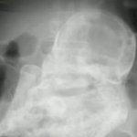 [추억파리여] 80대 할머니 몸에 44년 전 죽은 <b>태아</b>가