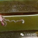 [추억파리여] 11살 소년 뇌에서 8cm 기생충 발견 충격