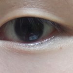 [조언부탁] 눈 <b>쌍수</b>해도 괜찮을까요?