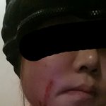 [꼭조언부탁] 피부과에서 화상입혀놓고 나몰라라하는 원장.. 도와주세요...