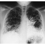 [추억파리여] <b>수은</b>먹고 자살 시도한 여자의 엑스레이
