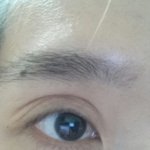 [도와주세요] 잘못된성형ㅜㅜ