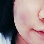[꼭댓글부탁] <b>코</b>랑 <b>입</b> 성형해야할까요 ?