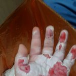 [조언부탁] 어린이집화상사고