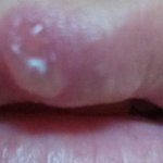 [댓글부탁] 입술 <b>물집</b> 어떡함)사진ㅇ