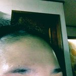 [꼭댓글부탁] <b>비절개</b>눈매교정. 한달넘엇어요