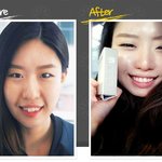 의료사고때문에 걱정되서 <b>노비</b>절라인으로 교정중인데