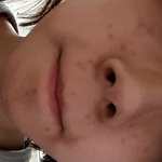 [댓글부탁] 여드름ㅠㅠㅠㅠㅠ(혐오주의)