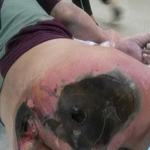 [도와주세요] <b>욕창</b> 관련 요양원 관리소홀.. 너무억울해요 도와주세요...