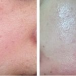 지긋지긋한 성인여드름에서 벗어나 피부미인 되기